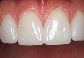 Elizabeth Smiline NJ, LLC | Dental Bridges, Teeth Whitening and Veneers