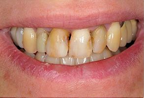 Elizabeth Smiline NJ, LLC | Root Canals, Ceramic Crowns and Implant Dentistry